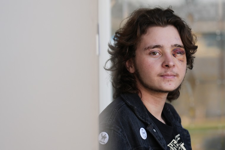 El caso de joven de California que perdió la vista en un ojo es un ...