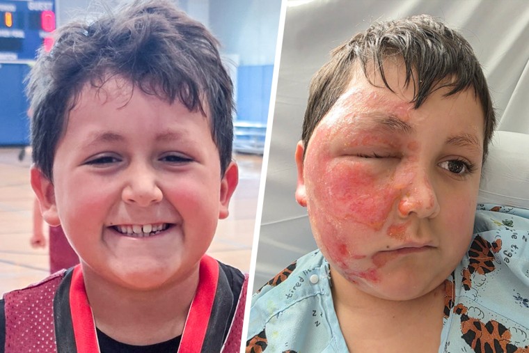 A diptych showing a young boy before and after he sustained a burn injury on his face.
