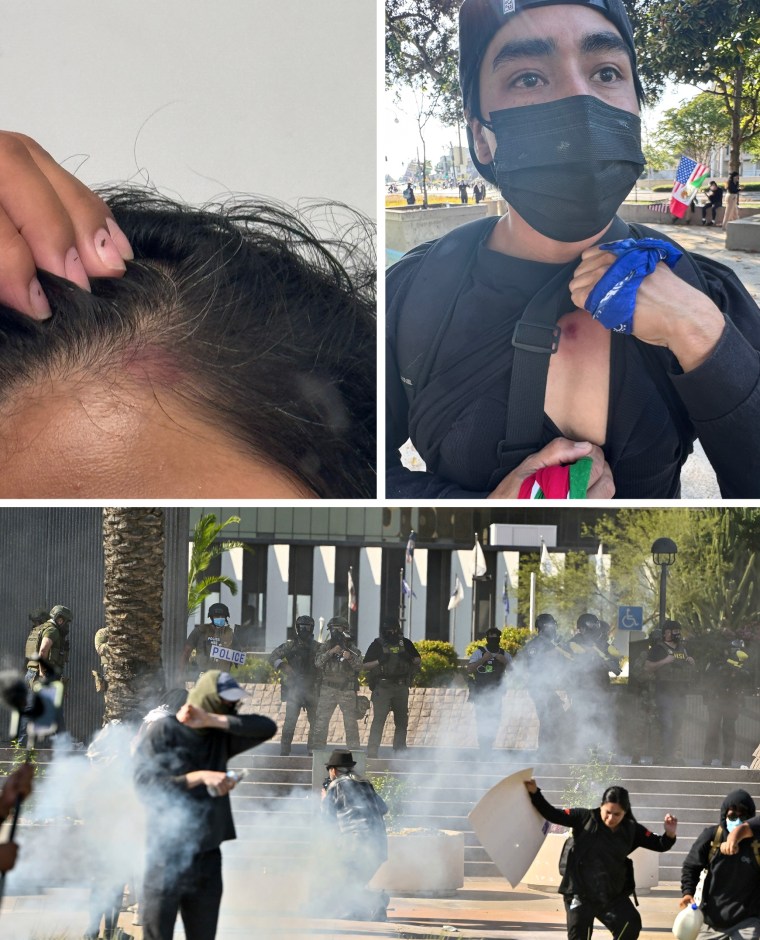 Abigail Olmeda and a friend were hit with rubber bullets outside a federal building in Santa Ana, Calif. 