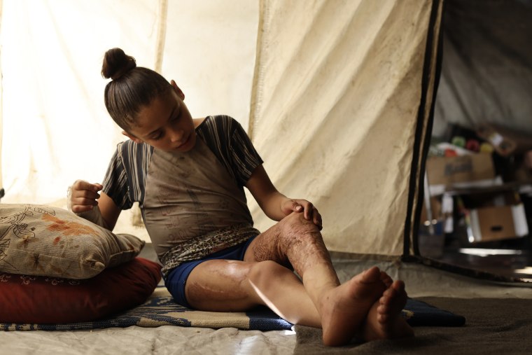 இஸ்ரேலிய தாக்குதலில் பலத்த காயமடைந்த பாலஸ்தீன குழந்தை நடக்க முடியாமல் தவிக்கிறது