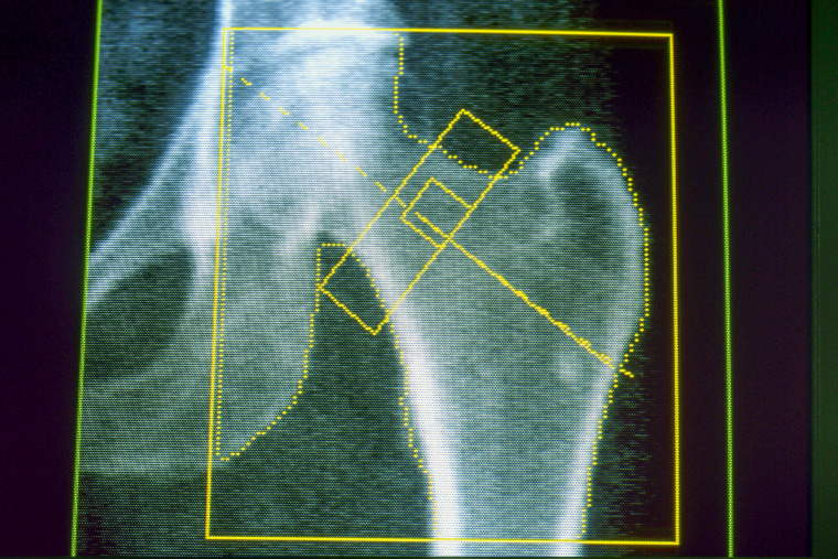 Bone Densitometry Result
