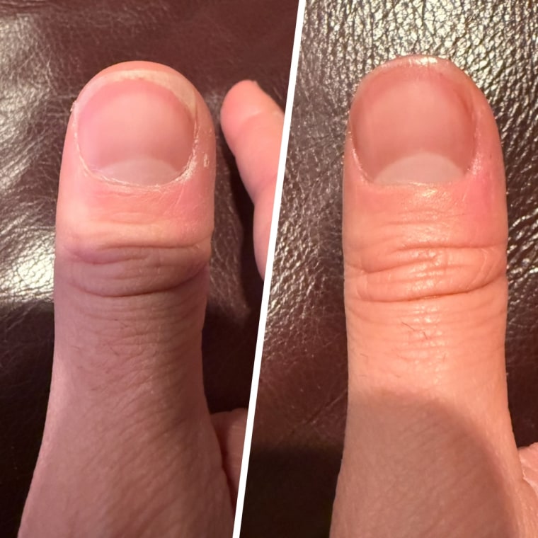 Associate producer Alexa Arent's finger before and after using the Sally Hansen Cuticle Treatment Pen.