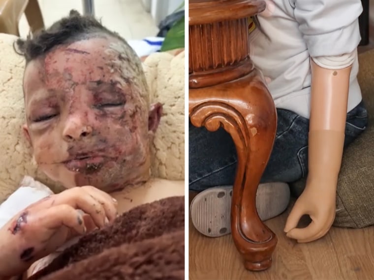 A split composite image of Omar's face injuries/burns, left, and a close up of his prosthetic arm