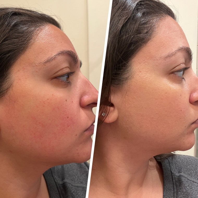 Jillian Gonzales, before and after using the Hero Cosmetics Rescue Balm Red Correct Green Cream.