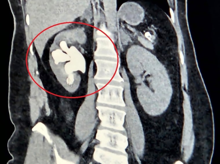 Anderson's kidney stone was a type called "staghorn" because it grows branches that look like antlers.