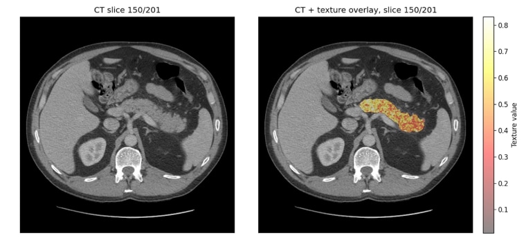 The REDMOD AI model analyzes a CT scan to detect early tissue changes associated with pancreatic cancer.