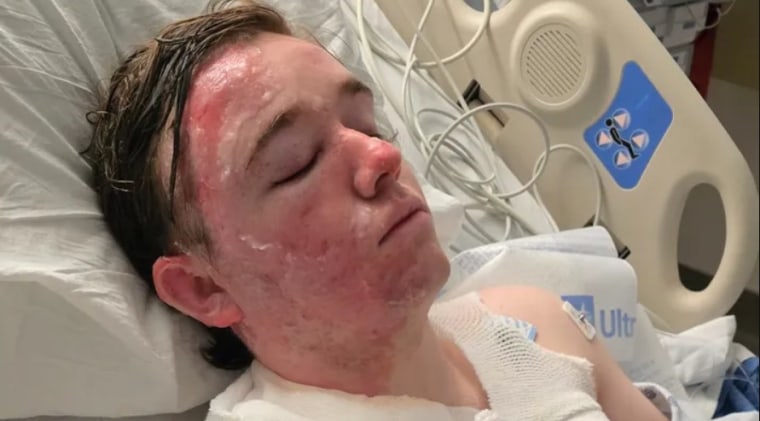 Jacob Smith, who police say was doused with hot liquid by a co-worker at a McDonald's in Yuba City, Calif., is recovering in the ICU burn unit at the University of California, Davis.
