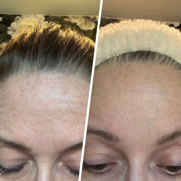Before and after using the Wrinkles Schminkles patch for three weeks.