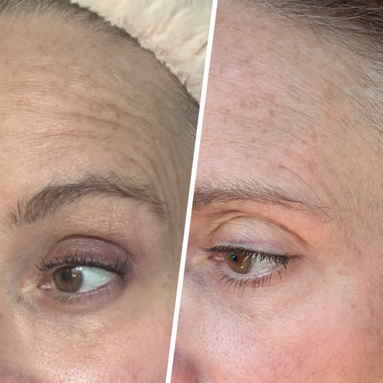 After using the Frownies patches to smooth wrinkles near my temples.