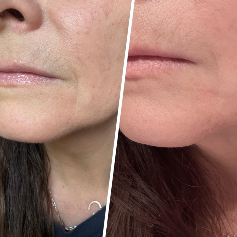 The Peace Out wrinkle patches helped the lines around my mouth fade almost immediately.