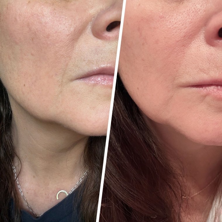 It only took one night to see difference in my smile lines after using the RoC deep wrinkle patches.