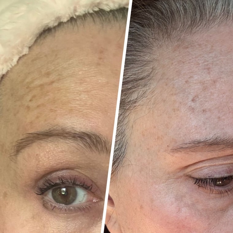 Before and after using the Skin Gym patches on the wrinkles near my temple.