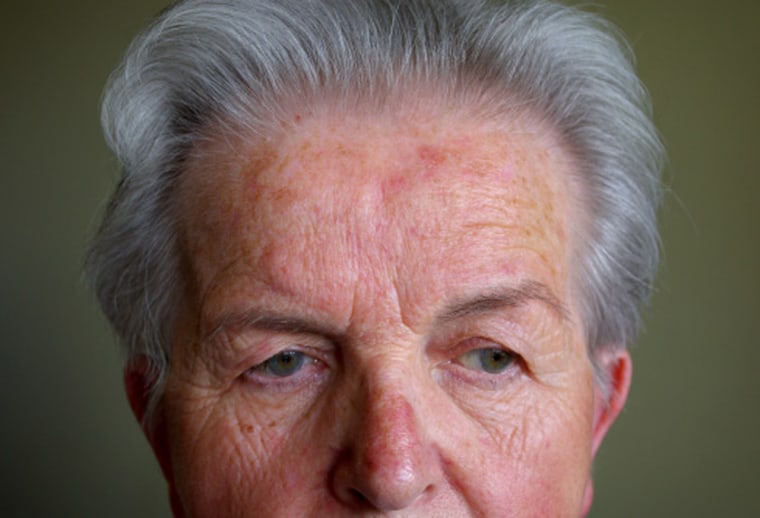 Rosacea can cause reddish skin, bumps, small visible blood vessels on the face and more. The skin condition affects an estimated 16 million in a U.S., according to The National Rosacea Society.