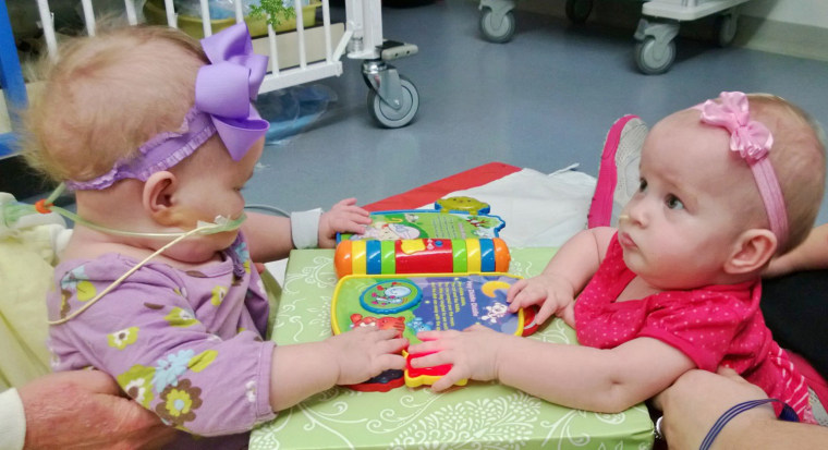 Allison and Amelia Tucker, 8-month-old twins who were born joined at the chest, are recovering well after a seven-hour separation surgery in November.
