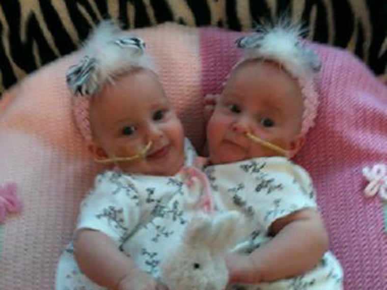 Here's a photo of Amelia and Allison Tucker before the surgery that separated them.