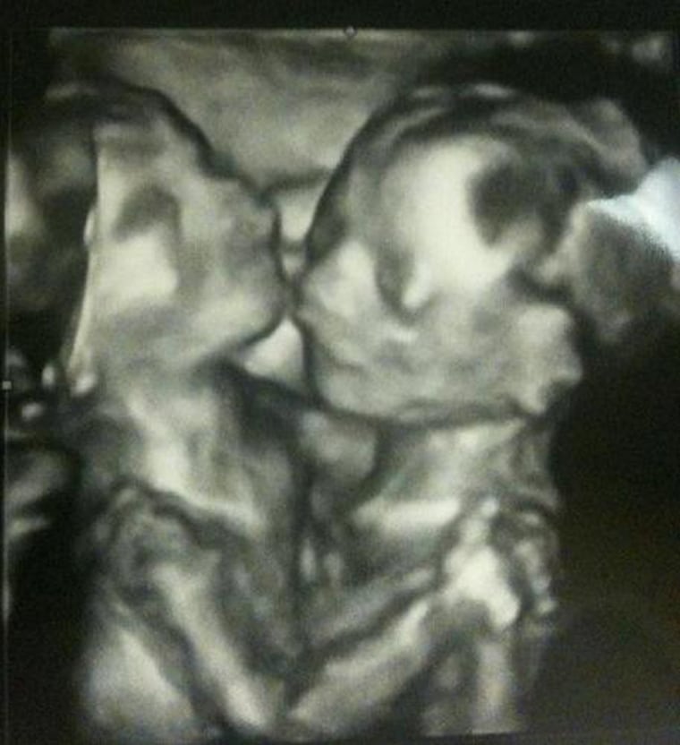 The still-conjoined Tucker twins embrace in the womb.