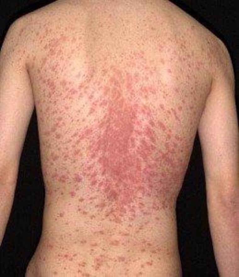 Happy holidays! Here is a rash shaped like a Christmas tree