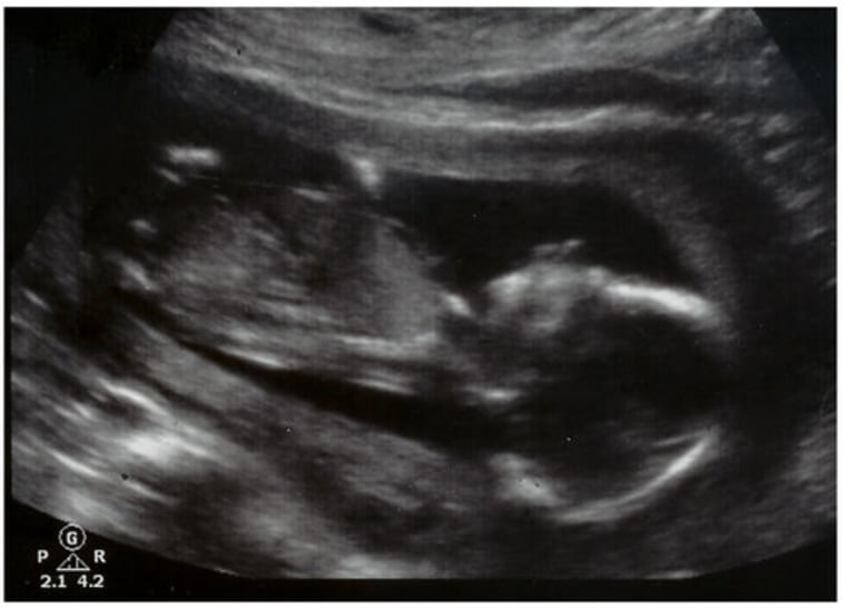 "Baby 'Wiggles' 16 week ultrasound image," reads the caption on birthornot.com