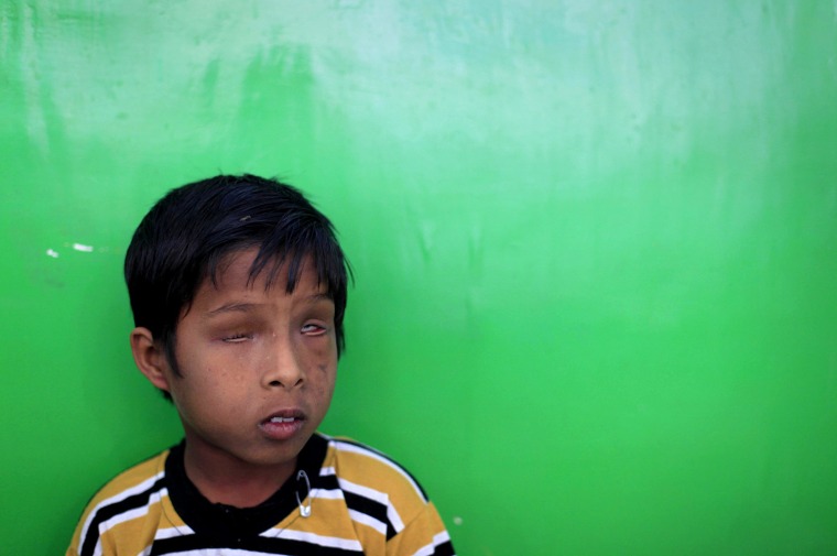 In this photo taken Tuesday, March 13, 2012, Deepak, 7, born mentally and physically disabled, a second generation victim of 1984 gas leak at the Union Carbide plant, waits to get his physiotherapy session at a clinic, in Bhopal clinic in Bhopal, India. The survivors of the tragedy of 27 years ago, with their lingering illnesses, sick children and dead relatives, faded away from the world's memory, even as their suffering went on. Now, though, they have seized on a new chance to force their plight in front of the world, the London Olympics. (AP Photo/Rafiq Maqbool)