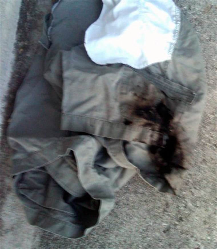 A photo released by the Orange County Fire Authority on May 17, shows Lin Hiner's cargo pants after beach rocks ignited in the pocket. The San Clemente, Calif., woman suffered third-degree burns in the incident.