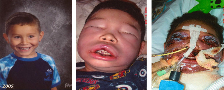 From left, Jake Finkbonner in kindergarten in 2005, Jake one day after he contracted flesh-eating bacteria, and Jake on his sixth birthday just eight days after the accident.