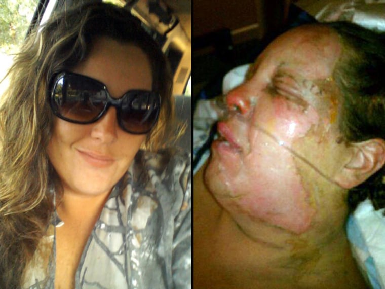 Kim Grice, shown before and after her face caught on fire during surgery Tuesday to remove cysts in her head.