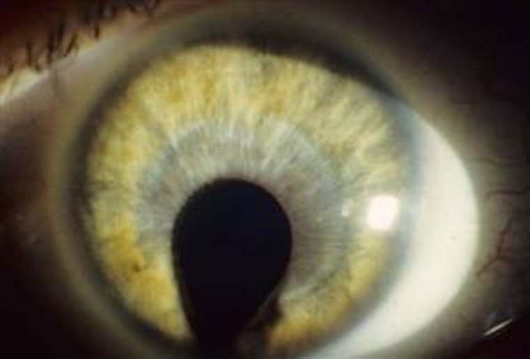 Patients with cat eye syndrome have a congenital defect that can make the pupils resemble a keyhole.