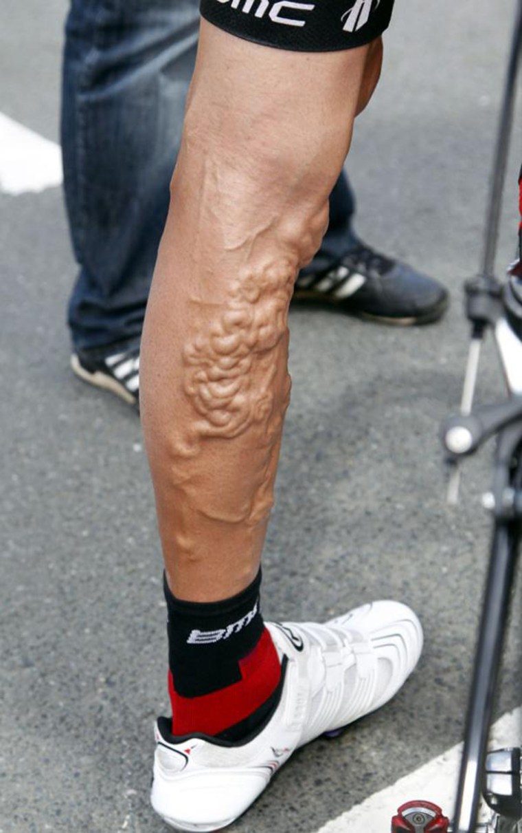 What is wrong with this Tour de France cyclist's leg?!