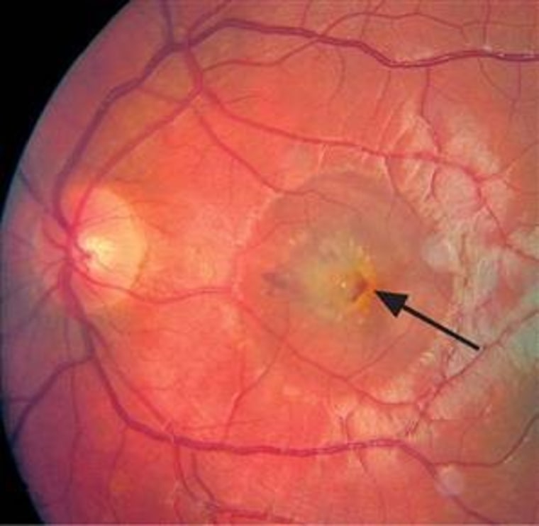 A photograph of the left eye of Swiss teen shows where he burned his retina with a laser pointer.
