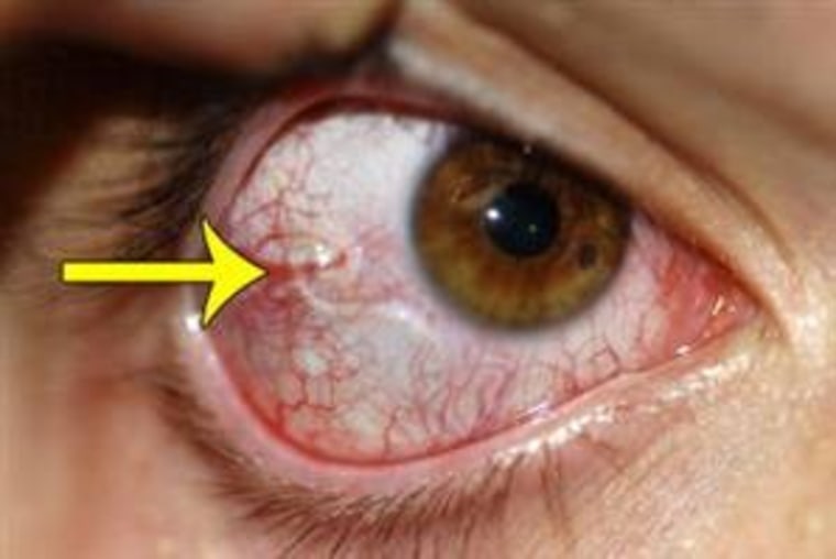 The arrow points out the African eye worm that set up a temporary camp in then-25-year-old Israel Orellana's eye.