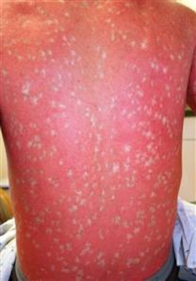 Itchthyosis with confetti leaves sufferers with red, scaly skin sprinkled with spots of normal pigment. Scientists hope it will help solve the riddle of other genetic disorders.