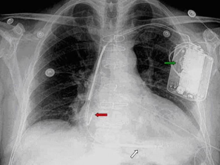 recycled-heart-devices-offer-new-life-in-poor-nation-study-finds