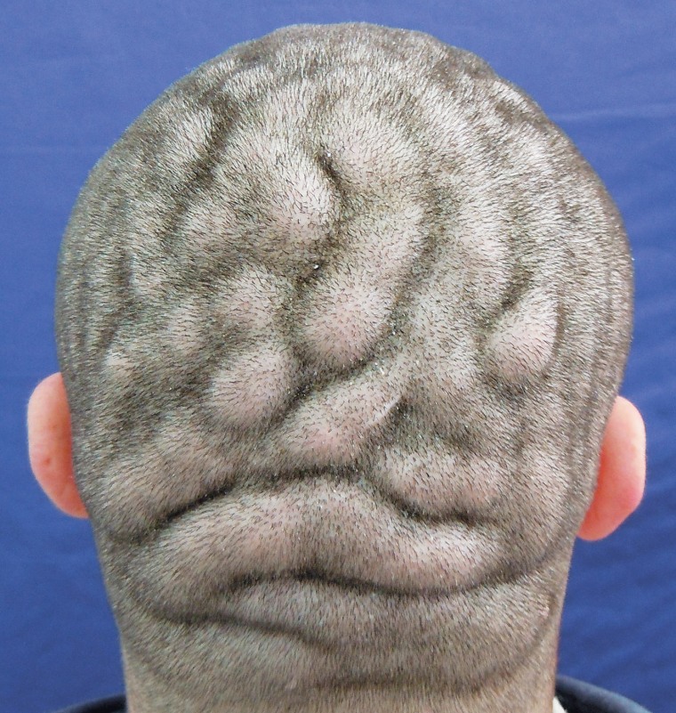 Condition makes man's scalp look like surface of brain