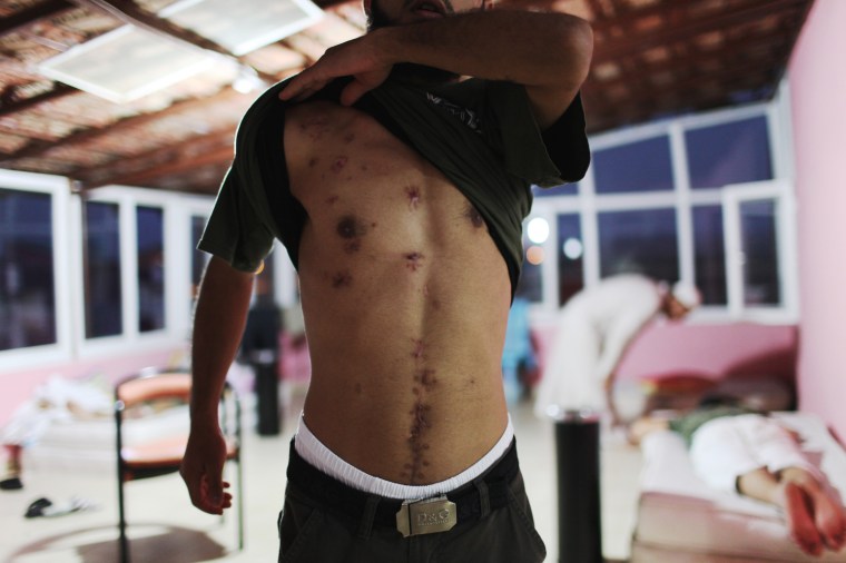 A wounded Syrian refugee shows his injuries after receiving medical treatment at the Reynhali State Hospital, on Sept. 20.