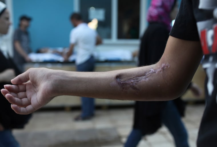 A wounded Syrian refugee shows his injuries after receiving medical treatment at the Reynhali State Hospital on Sept. 20.