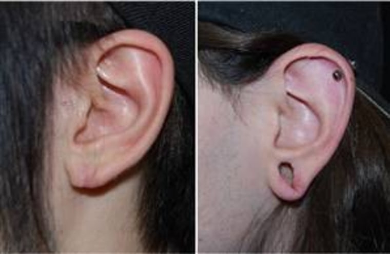 On the left, Daniel Bocchino's ear lobe is intact after surgery. On the right, his lobe is still holey.