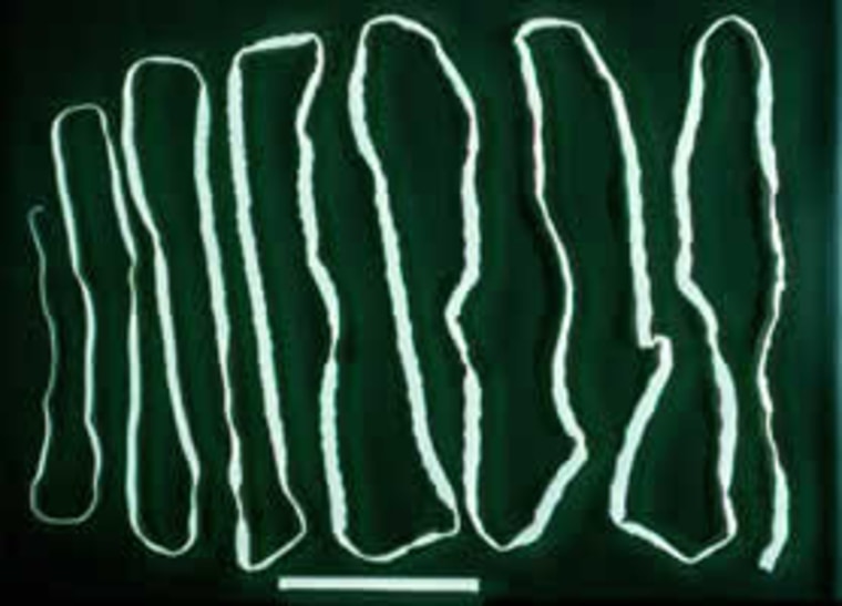 Iowa woman tries tapeworm diet prompts doctor warning