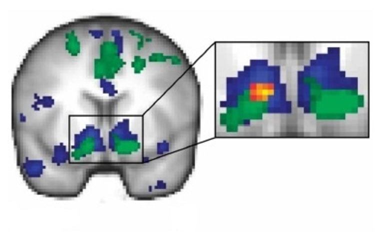 Image: Brain scan