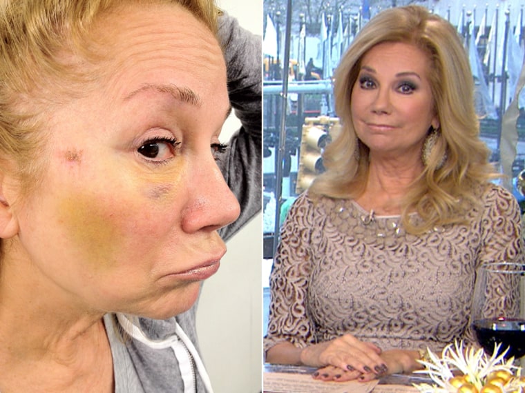 Kathie Lee's bruise, left, after running to meet a delivery man.