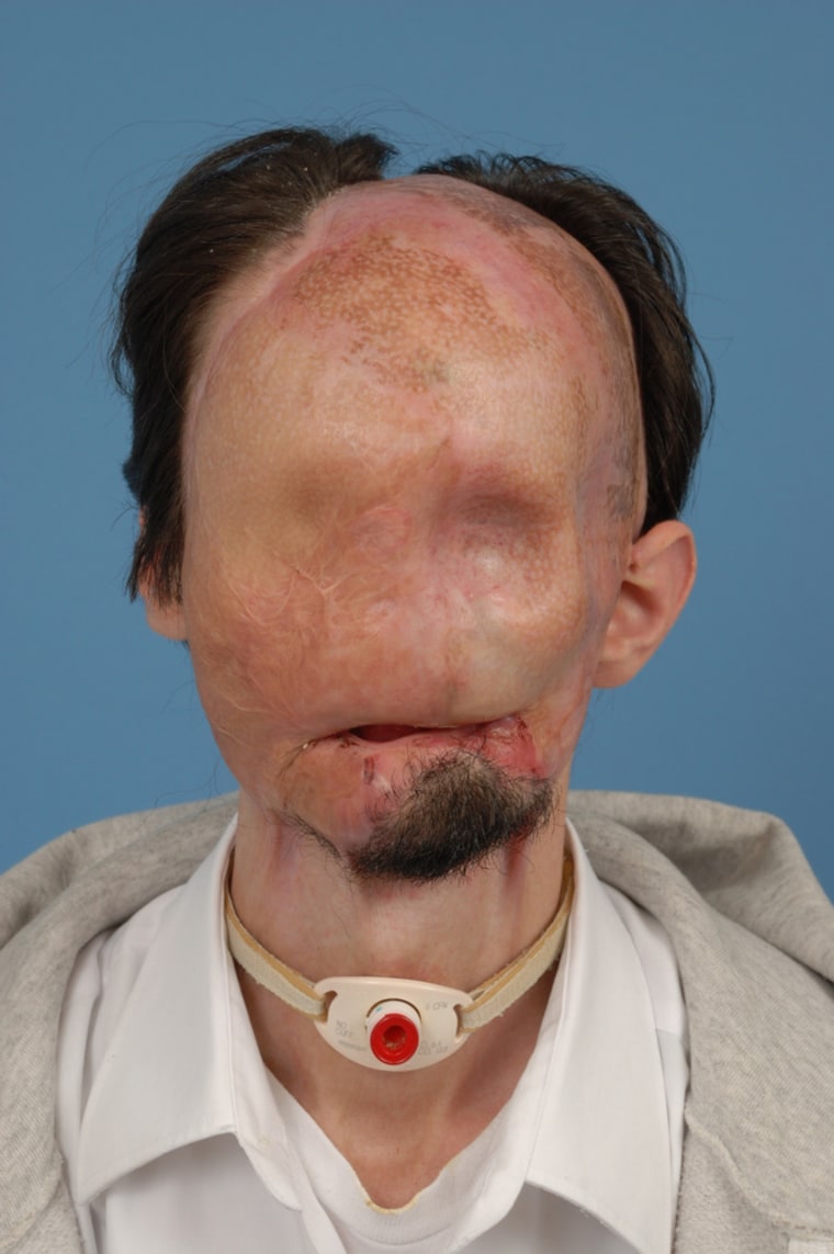 Dallas Wiens in 2010, before his face transplant.