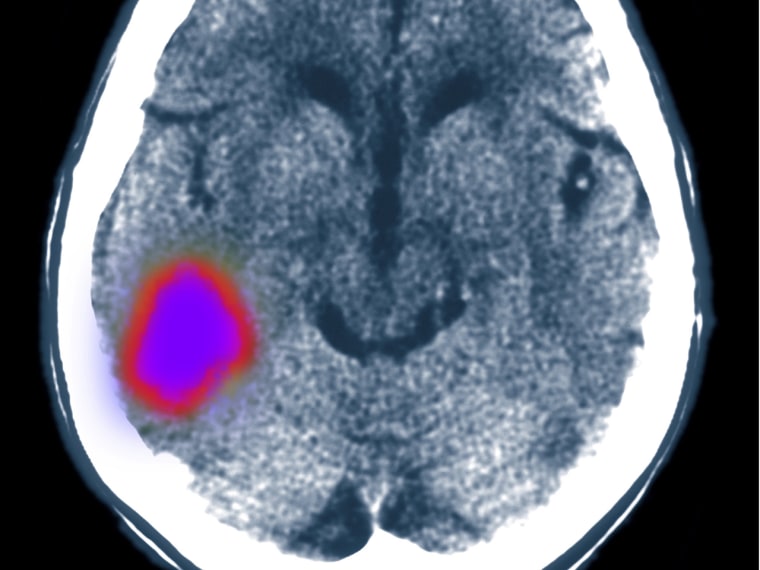 Cerebral CT scan showing stroke