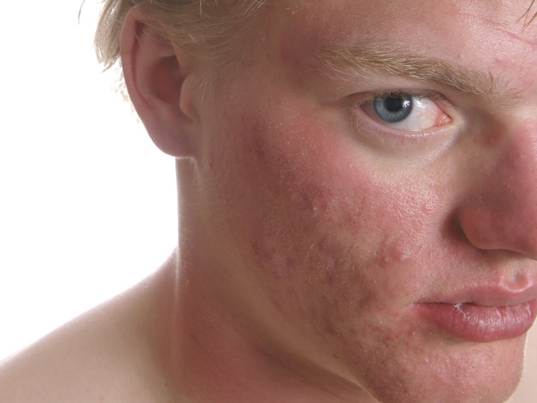 Could good germs fight acne? A new study suggests so.