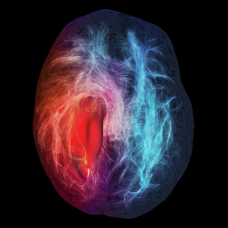 \"Cerebral Infiltration\" won honorable mention and People's Choice in the illustration category. The image is the result of fiber tractography from diffusion-weighted magnetic resonance imaging. It illustrates the structural connections contained in the white matter of the brain. The red, smooth surface represents a glioblastoma tumor. Blue fibers indicate that the fibers are located a safe distance away from the tumor, while the red fibers are in a close perimeter to the tumor and can cause severe post-operation deficits if they are cut. The illustration is by Maxime Chamberland, David Fortin and Maxime Descoteaux.