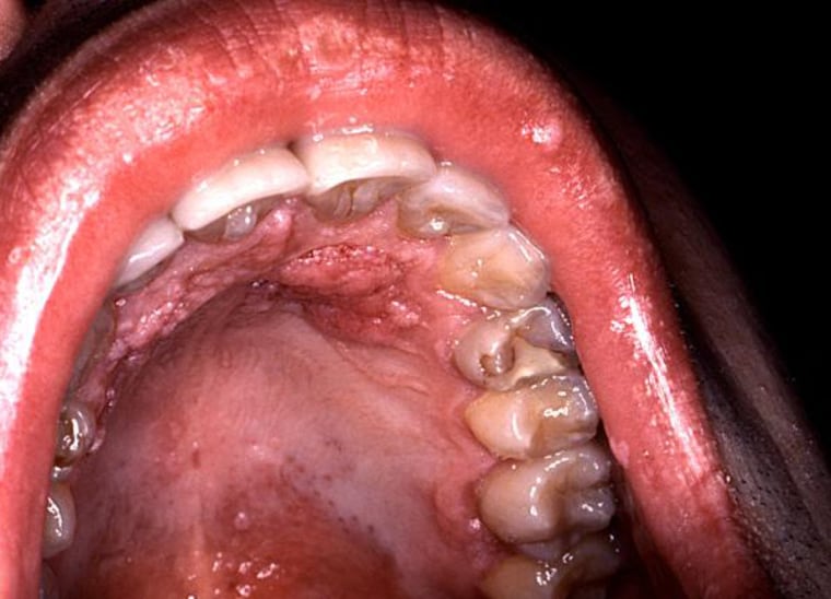 The human papilloma virus can cause head, neck, mouth, cervical and penile cancers.