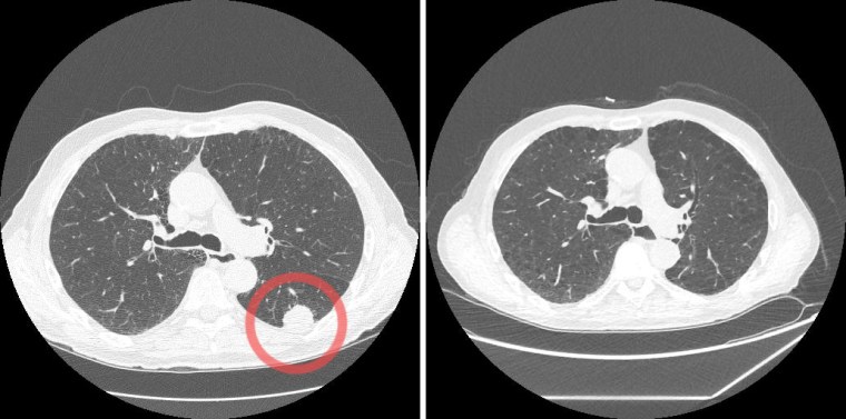 CT scans