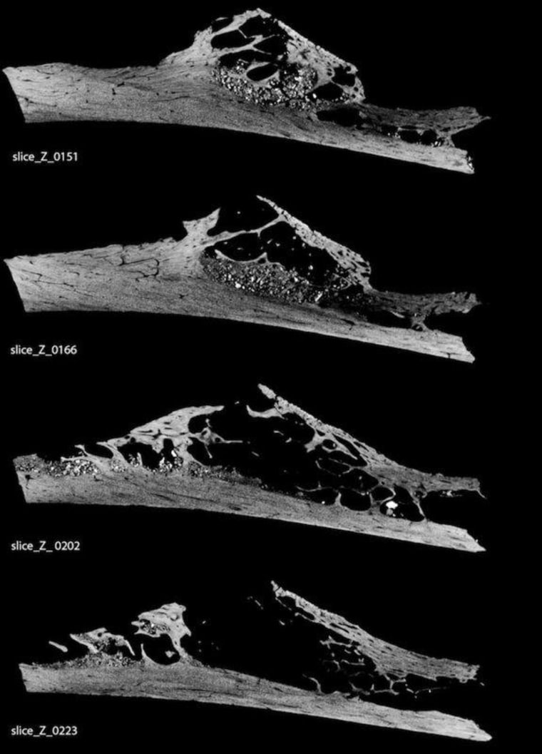 A MicroCT scan of a 120,000-year-old Neanderthal rib reveals eaten-away bone, evidence of a soft-tissue tumor.