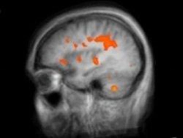 This functional magnetic resonance image shows areas of heightened brain activity when a father hears his own child's cries. Notable areas of activity include the frontal cortex, insula putamen, thalamus and superior temporal cortex.