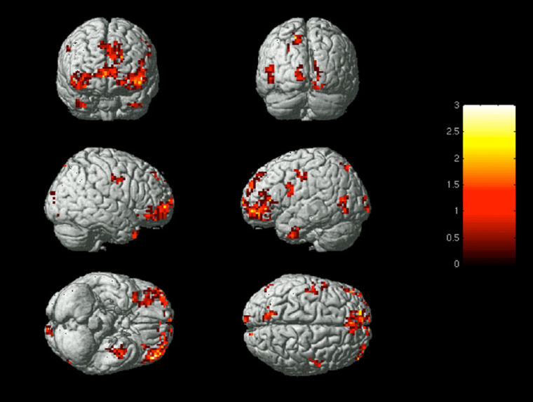 Functional magnetic resonance imaging (fMRI) scans show the activation patterns when a brain experiences emotion