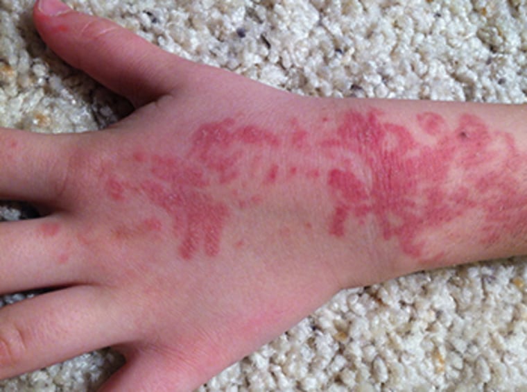 A 5-year-old developed severe reddening where the tattoo was placed.