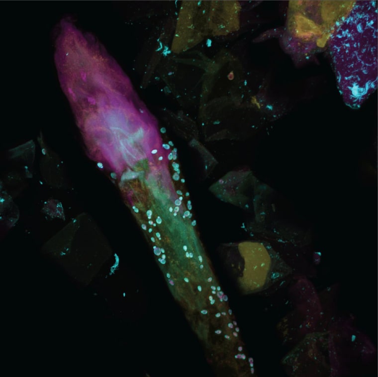 Bacteria and fungi surround a hair follice, as seen under a fluorescent microscope.Fungi appear blue-green, bacteria appear pink and skin cells and the hair shaft appears yellow.